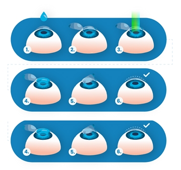 Ilustração da cirurgia LASIK